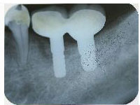 �C���v�����g���