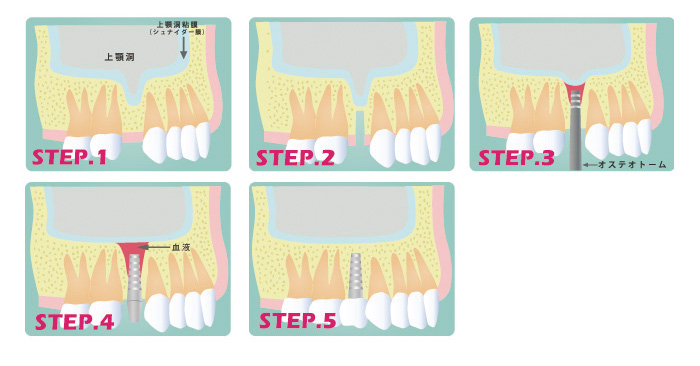 ソケットリフトの流れ|おおだち歯科